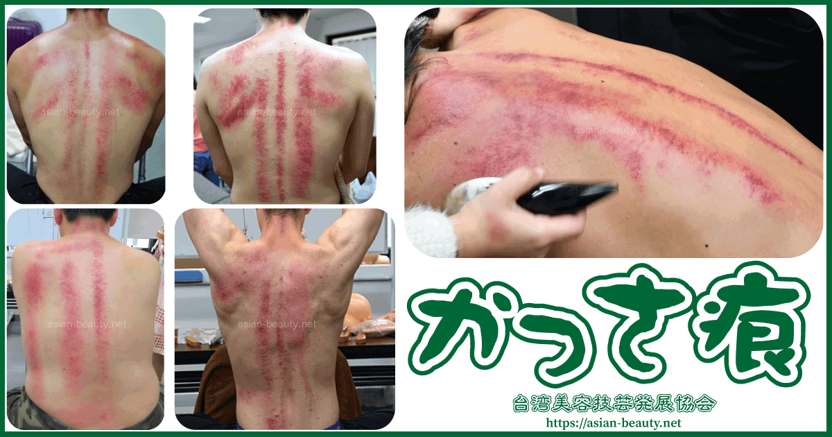 かっさをすると あざ や 内出血 のようなかっさ痕が出る 台湾美容技芸発展協会